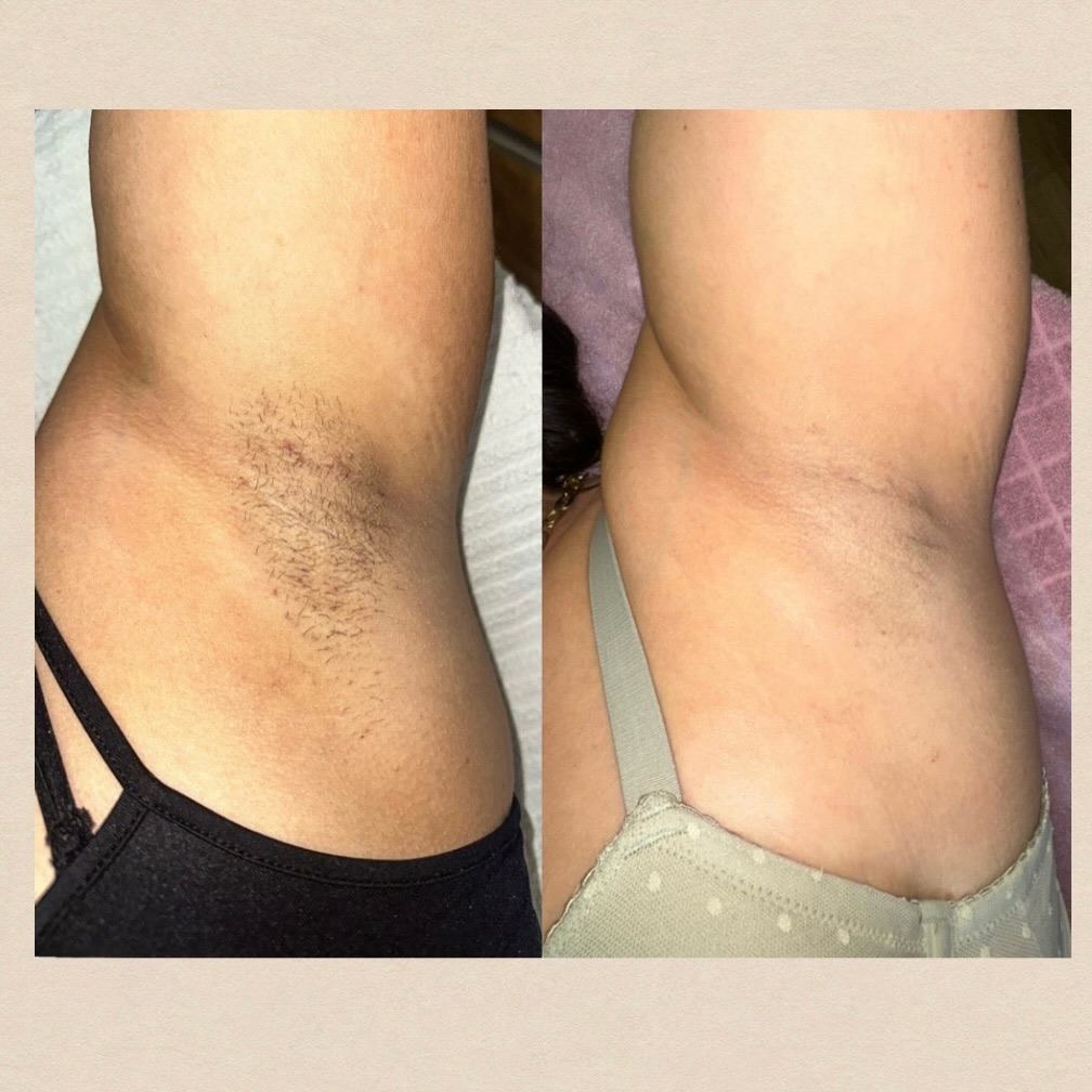 Achseln vor und nach der Laserbehandlung