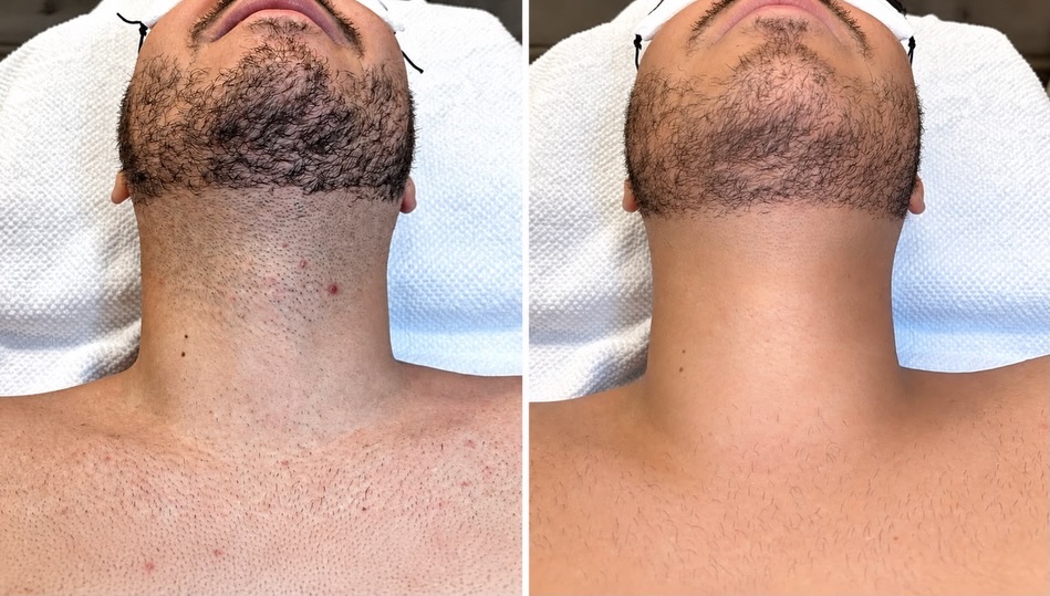Bartkonturen vor und nach der Laserbehandlung