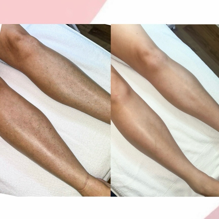 Unterschenkel vor und nach der Laserbehandlung